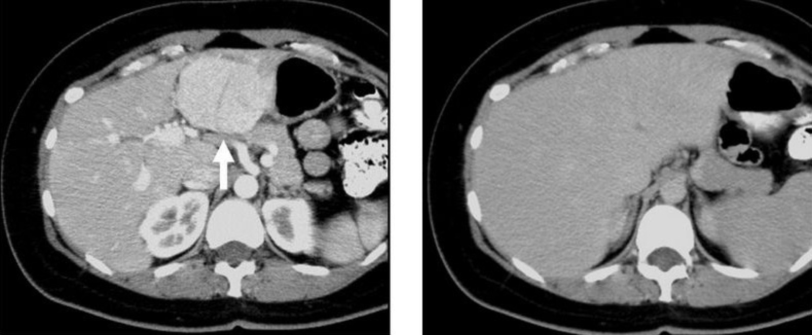 TC de hiperplasia nodular focal em fase arterial tardia (esquerda) e fase portal (direita): lesão hipercaptante ao redor com a área central (seta) que não realça — a cicatriz central.
