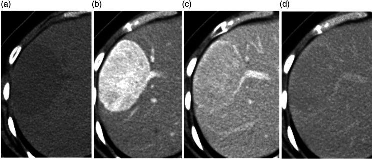 TC dinâmica de adenoma hepático em quatro fases: sem contraste, arterial com realce e artéria nutridora, portal e tardia com lavagem do contraste.