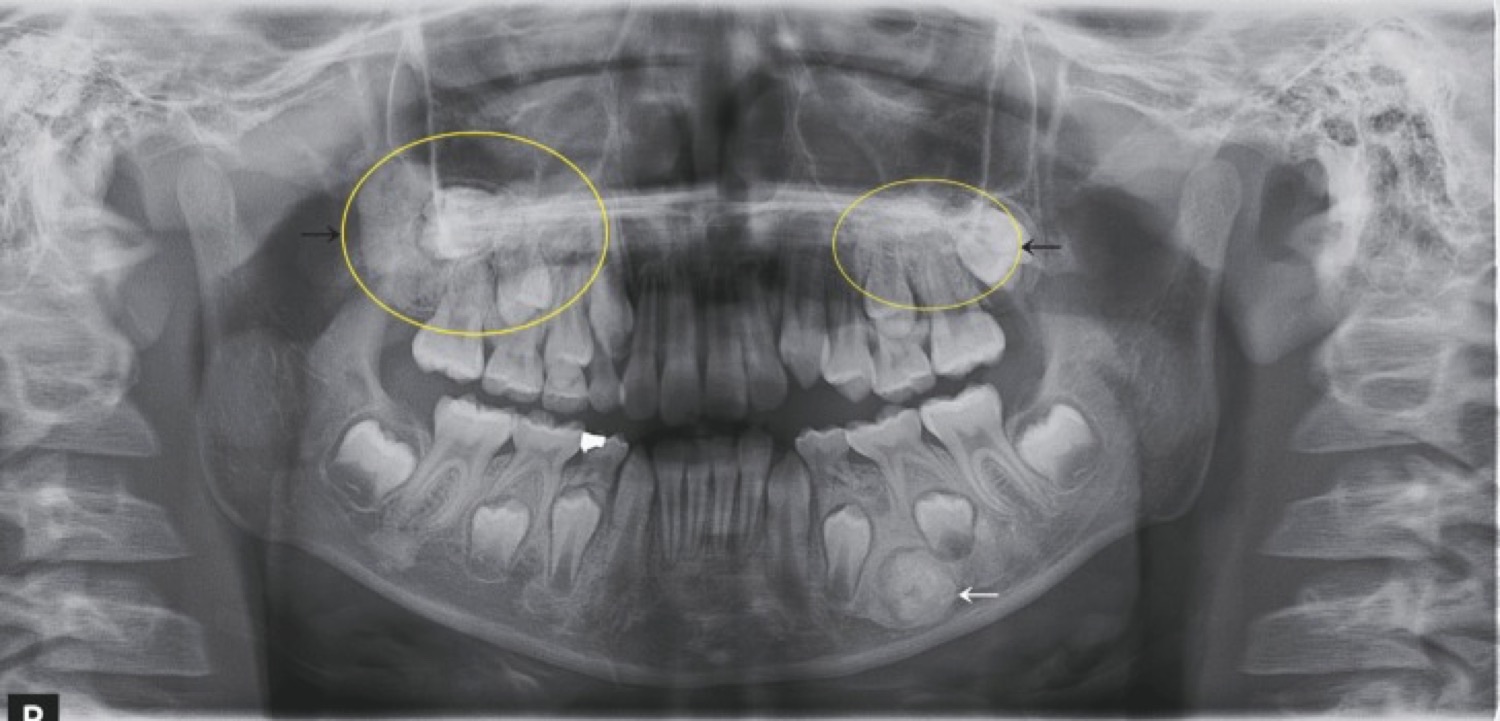 Radiografia panorâmica de mandíbula e maxila com múltiplas radiopacidades arredondadas e bem definidas, correspondendo a osteomas da síndrome de Gardner.