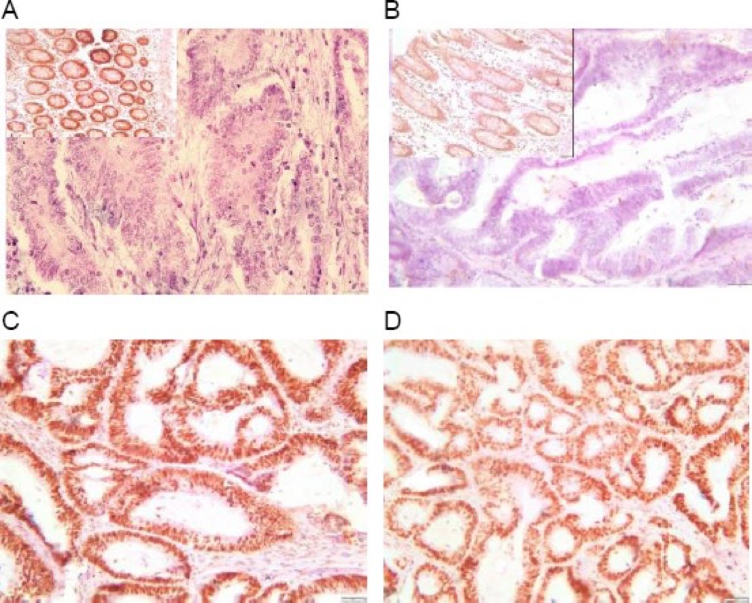 Painel de imuno-histoquímica de carcinoma colorretal MSI-H: perda da marcação nuclear de MLH1 e PMS2 com controle interno positivo, e marcação preservada de MSH2 e MSH6.
