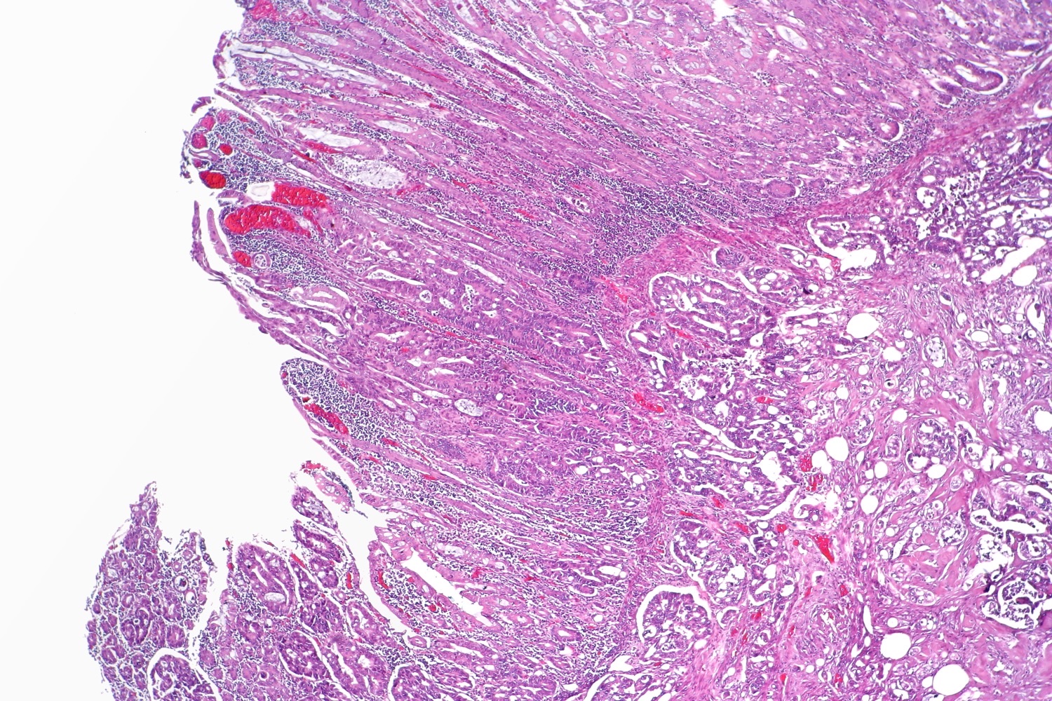 Lâmina de H&E em baixo aumento mostrando, na mesma peça, um adenoma tubular com displasia de alto grau à esquerda em transição para adenocarcinoma colorretal invasivo à direita.