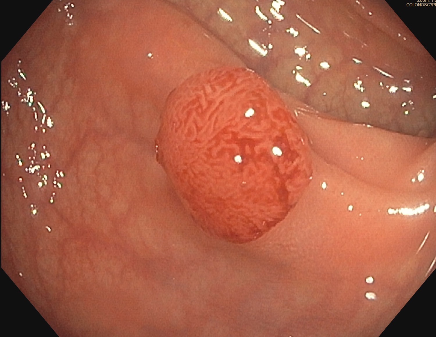 Imagem de colonoscopia de um pólipo adenomatoso colorretal projetando-se da parede do cólon.