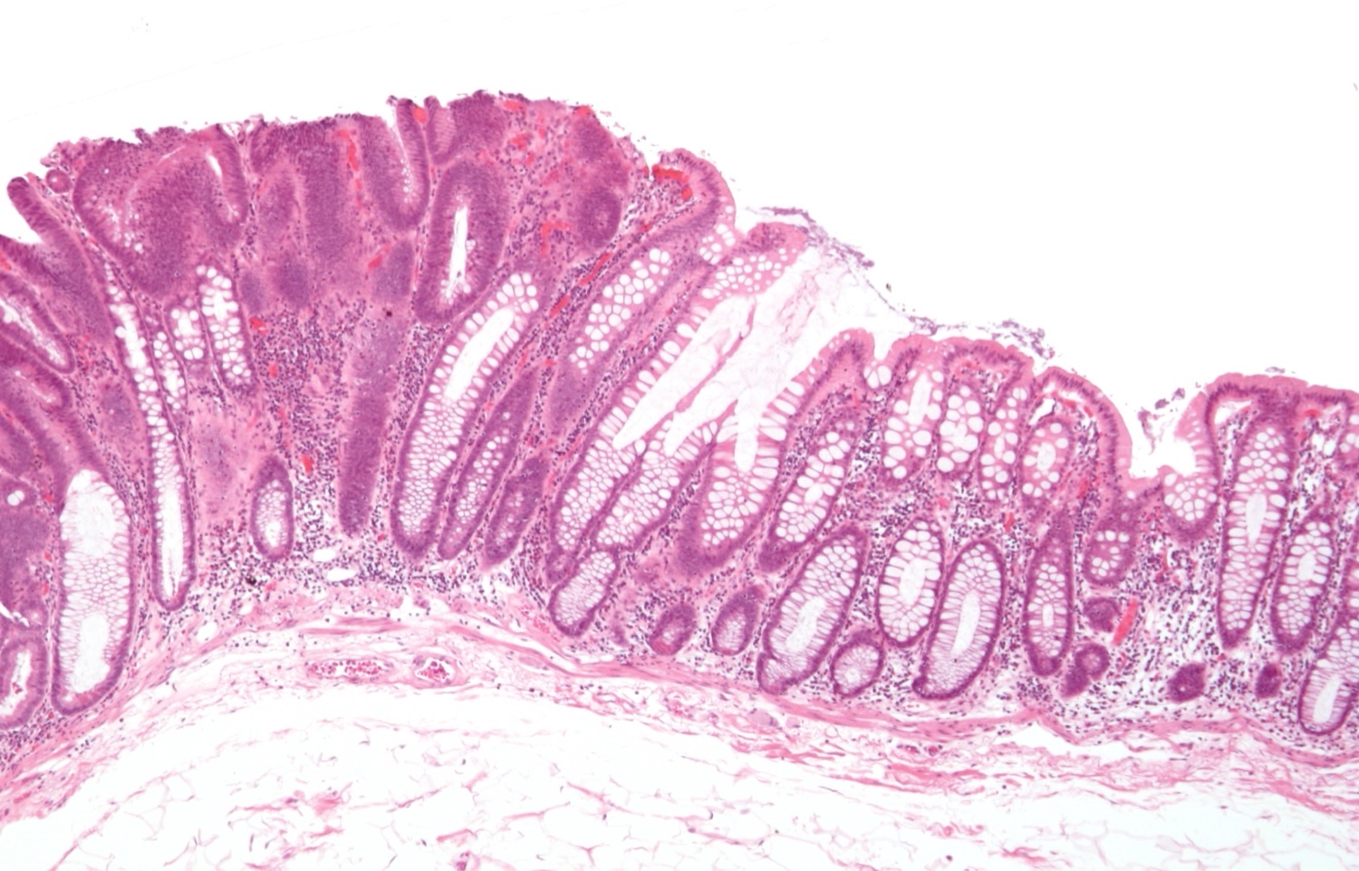 Lâmina de H&E de adenoma tubular: epitélio displásico com núcleos alongados e escuros em paliçada à esquerda, ao lado de mucosa colônica normal à direita.
