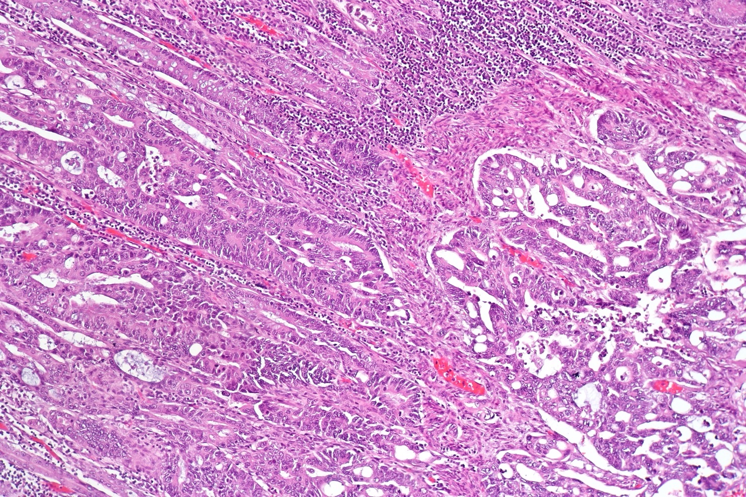 Lâmina de H&E em aumento intermediário: adenoma tubular com displasia de alto grau à esquerda e adenocarcinoma colorretal invasivo à direita, o carcinoma surgindo no pólipo.
