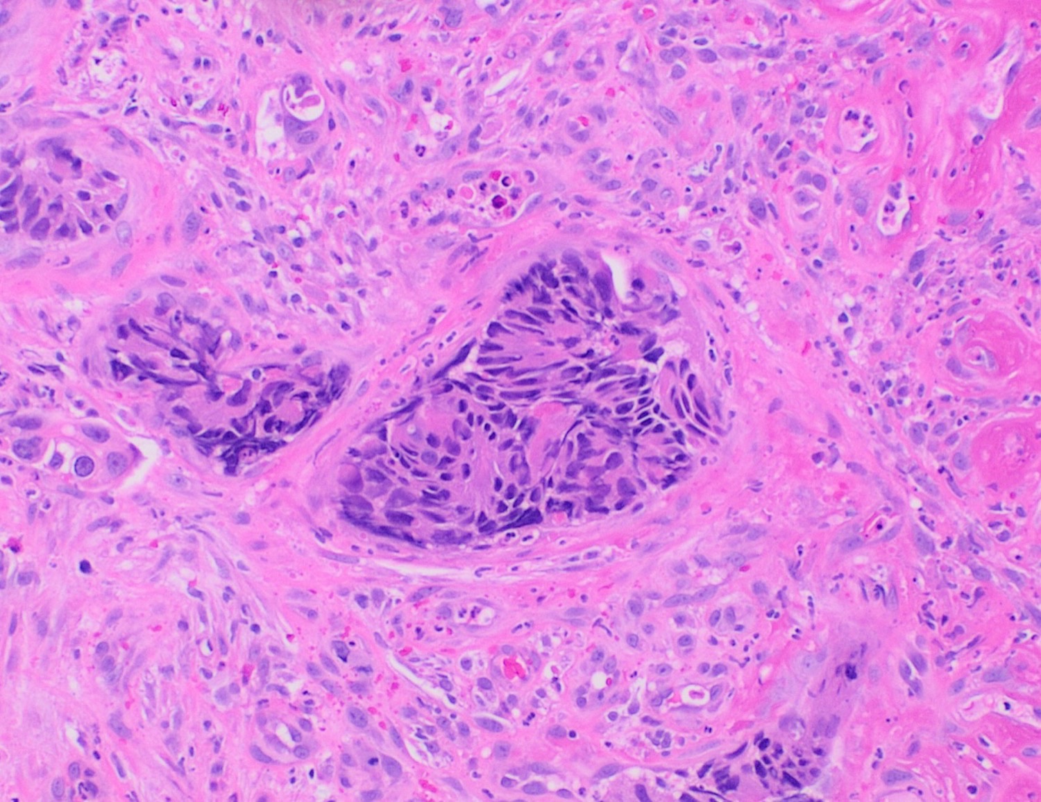 Lâmina de H&E de adenocarcinoma colorretal com um ninho de células tumorais dentro de um espaço linfovascular da parede.