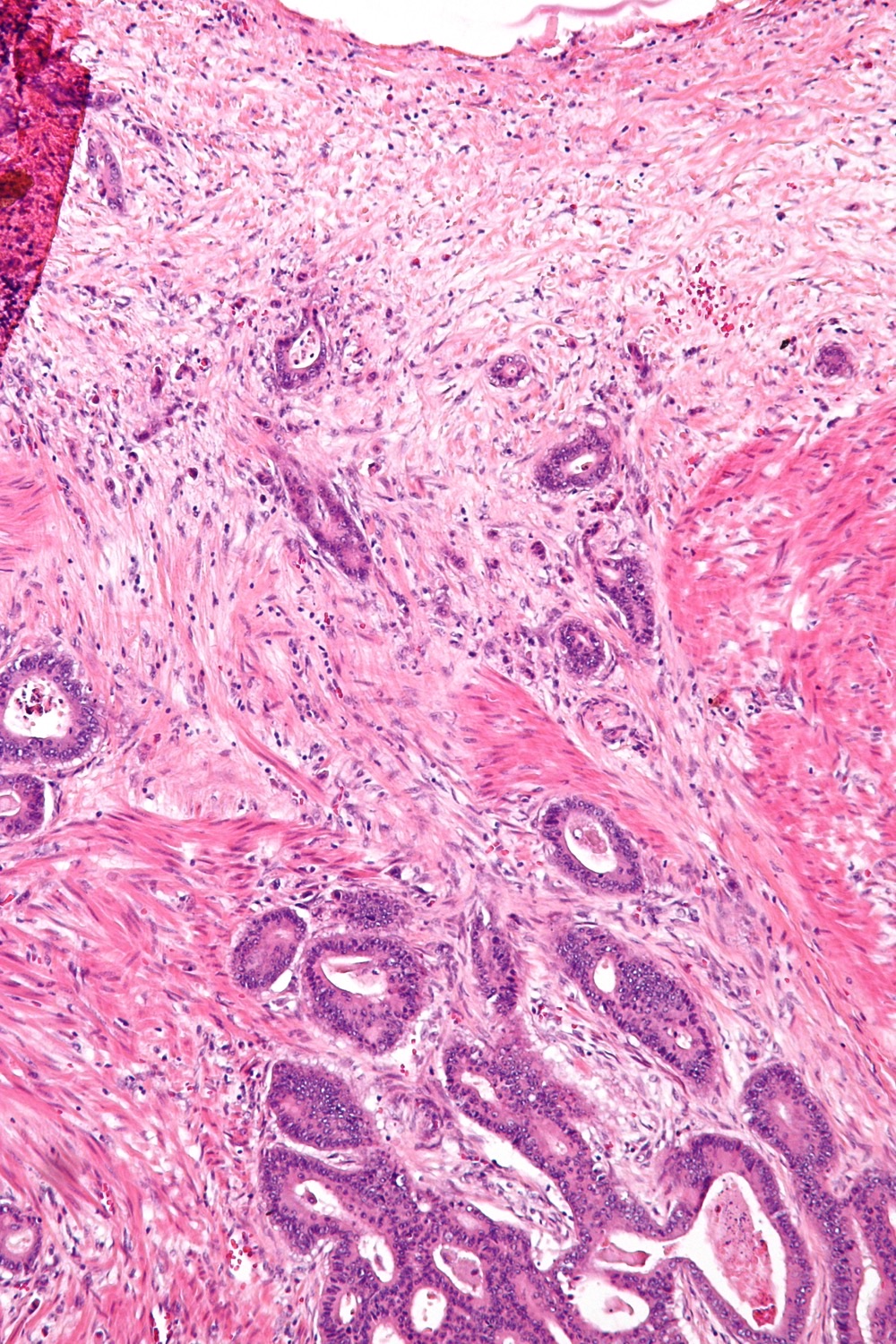 Lâmina de H&E de carcinoma colorretal com tumor budding: células tumorais isoladas e pequenos ninhos destacando-se na frente de invasão.