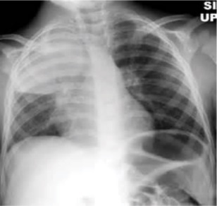 Radiografia de tórax PA com densidade nodular única de bordas distintas em parênquima preservado, sem opacificação do espaço aéreo ao redor.