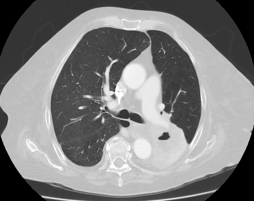 Corte de TC de tórax com carcinoma escamoso cavitado de parede espessa, infra-hilar.