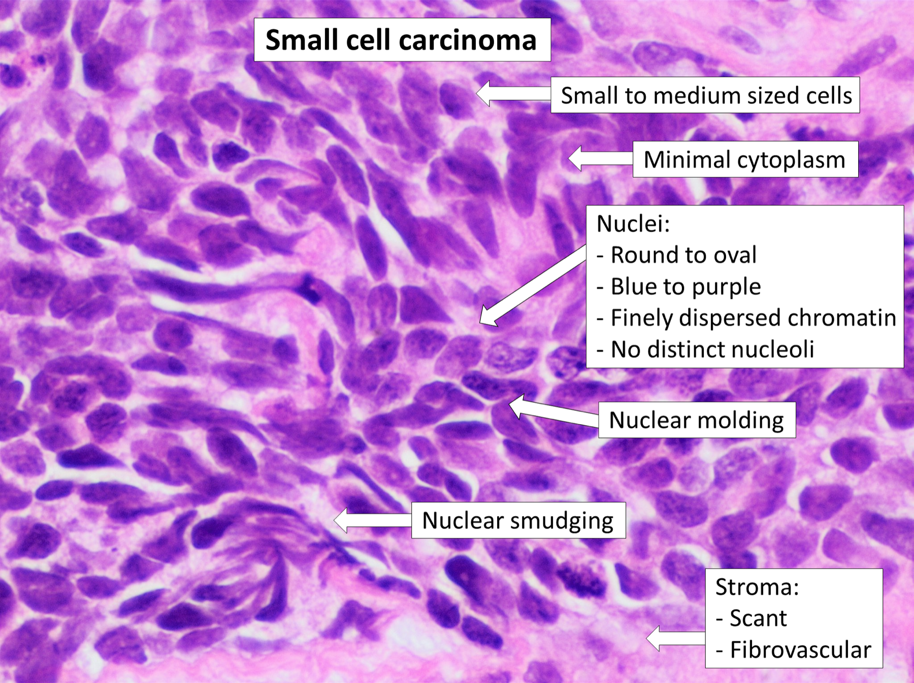 Microscopia anotada de carcinoma de pequenas células com núcleos hipercromáticos amontoados e citoplasma quase ausente.