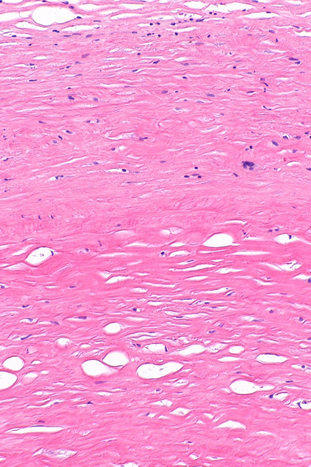 Micrografia de placa pleural hialinizada, marca histológica de exposição ao asbesto.