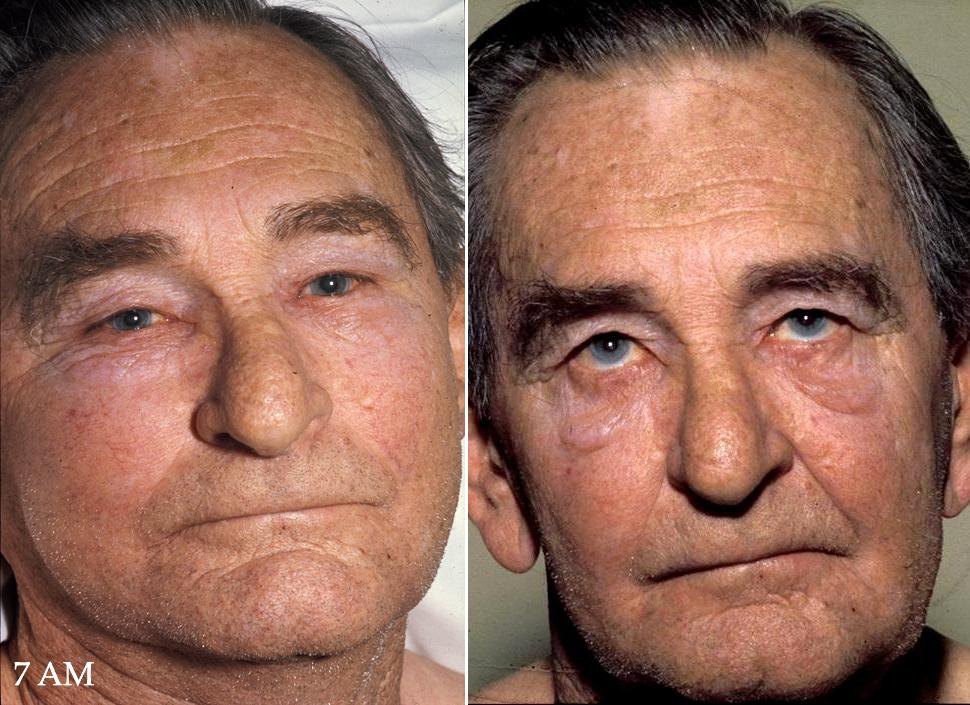 Paciente com síndrome da veia cava superior: edema e pletora facial com circulação colateral na parede torácica.