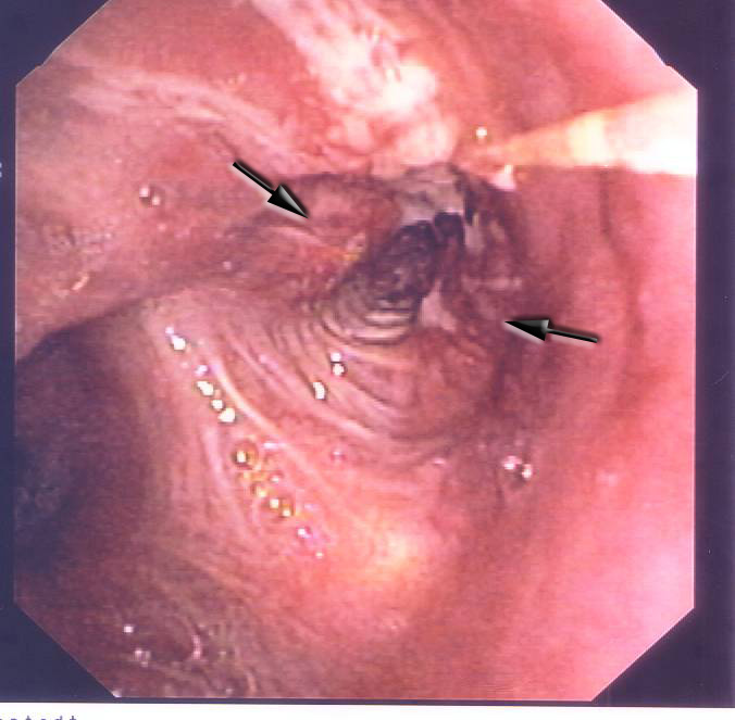 Visão de broncoscopia com tumor invadindo a luz do brônquio.
