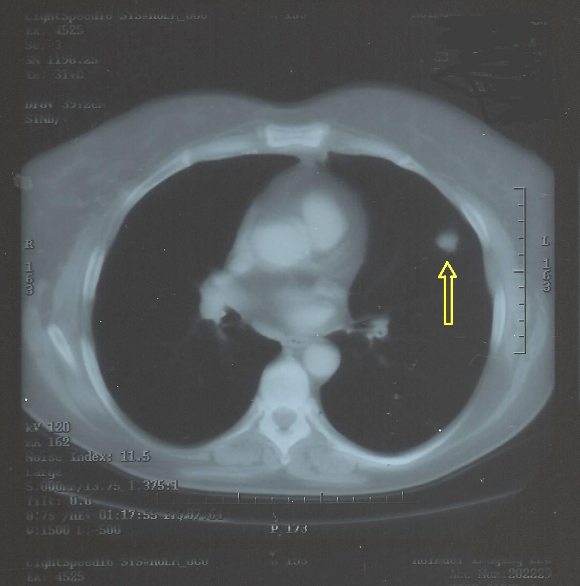 Corte axial de TC de tórax com nódulo pulmonar solitário indicado por seta, com contorno e densidade visíveis.