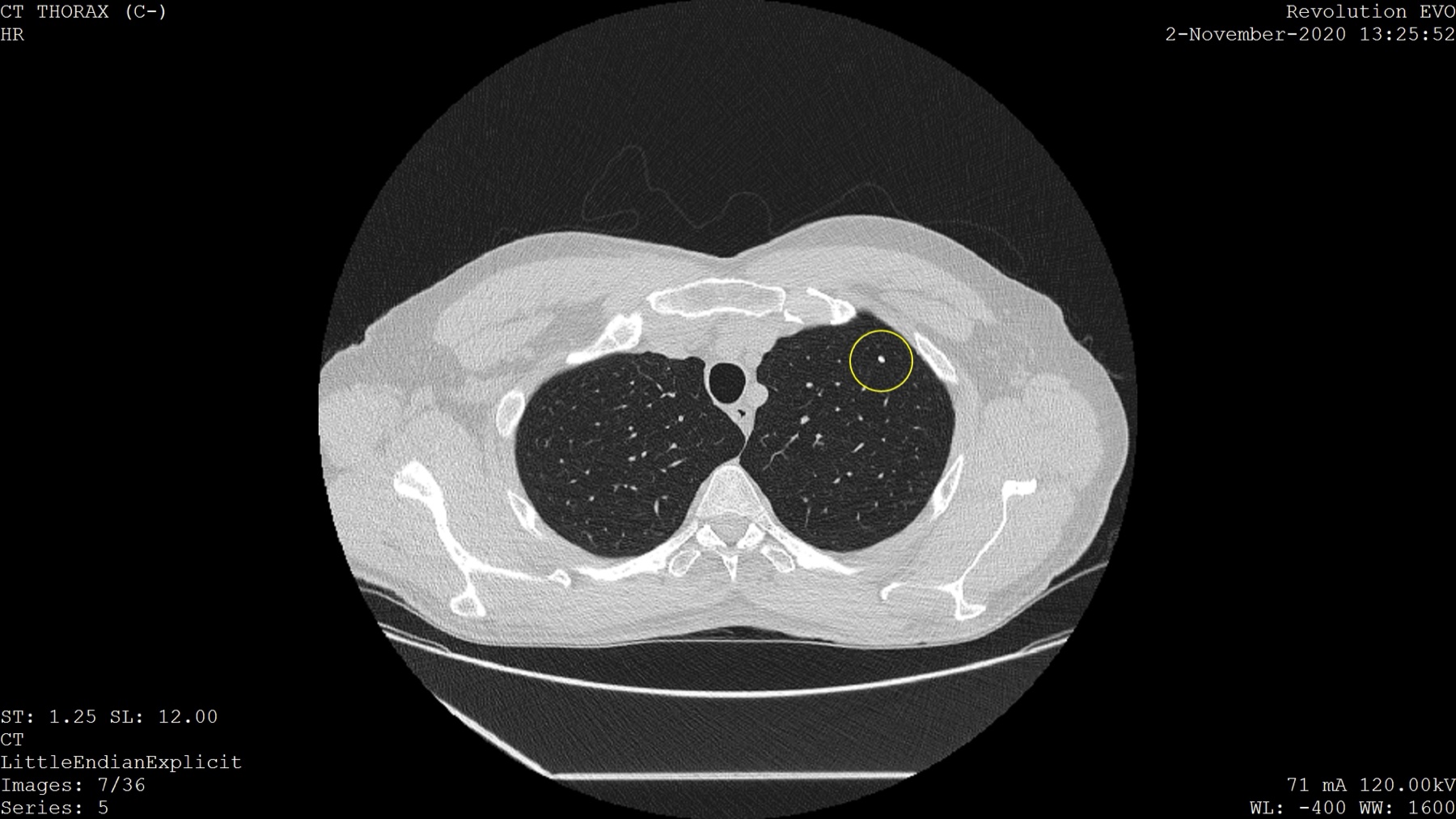 TC de tórax de baixa dose mostrando nódulo pulmonar calcificado destacado em amarelo.