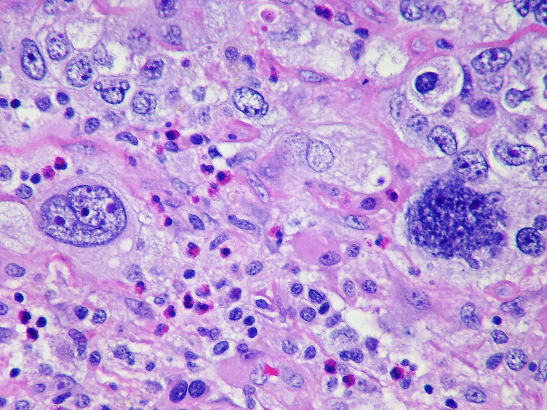 Amostra de encéfalo com implante secundário de adenocarcinoma de pulmão pouco diferenciado.
