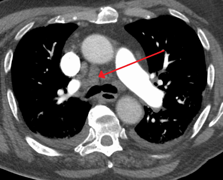 Imagem radiológica de tórax com linfadenopatia mediastinal volumosa.
