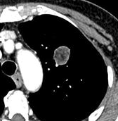 Corte de TC de tórax com hamartoma pulmonar contendo gordura interna e calcificação em grumos tipo pipoca.