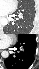 TC de tórax com nódulo pulmonar solitário bem delimitado, com calcificação interna de aspecto benigno e sem crescimento.