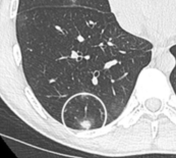 Corte de TC de tórax com nódulo subpleural pequeno, de contorno liso, sem padrão de calcificação suspeito.