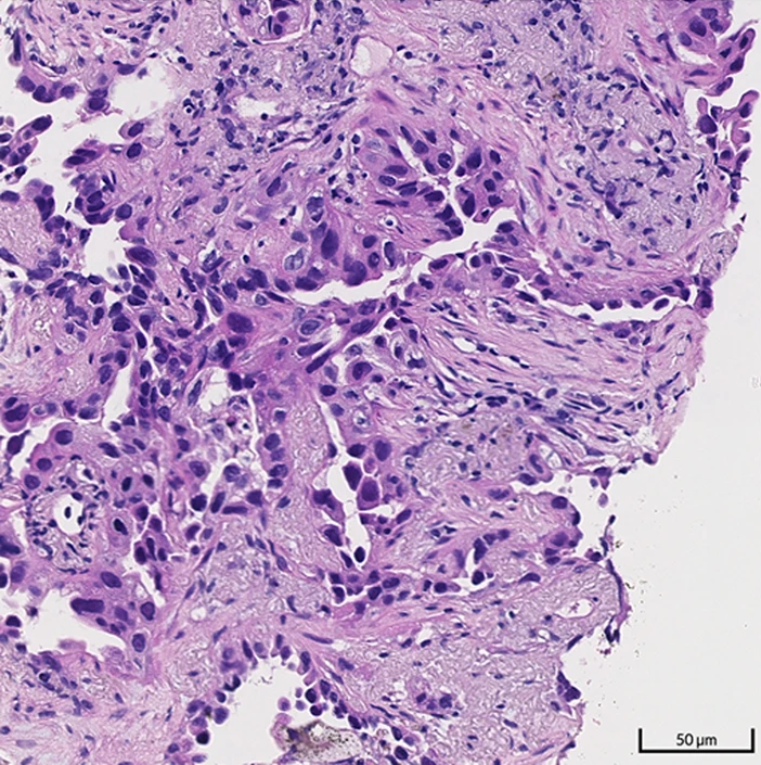 Histologia de adenocarcinoma de pulmão com padrão acinar, formação glandular.