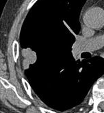 Corte de TC de tórax com nódulo subpleural periférico e retração pleural.