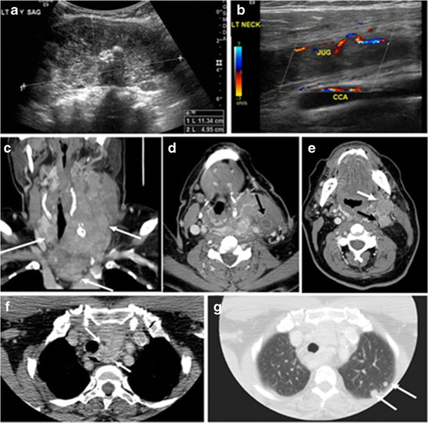 Tomografia e ultrassom de massa tireoidiana invasiva, pouco diferenciada, com compressão cervical.