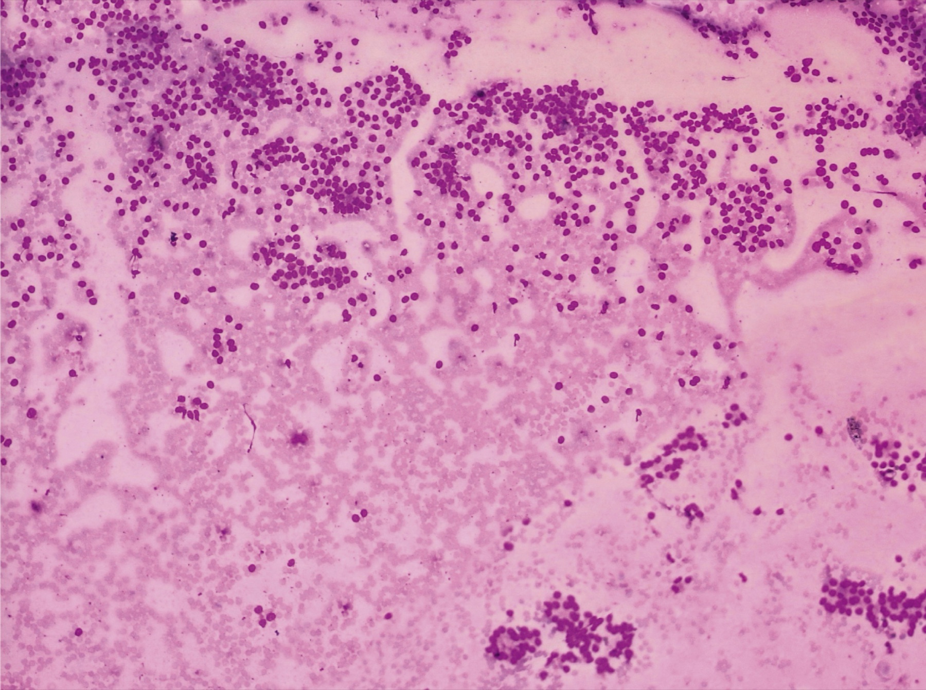 Citologia de PAAF de tireoide com arranjo microfolicular — neoplasia folicular Bethesda IV.