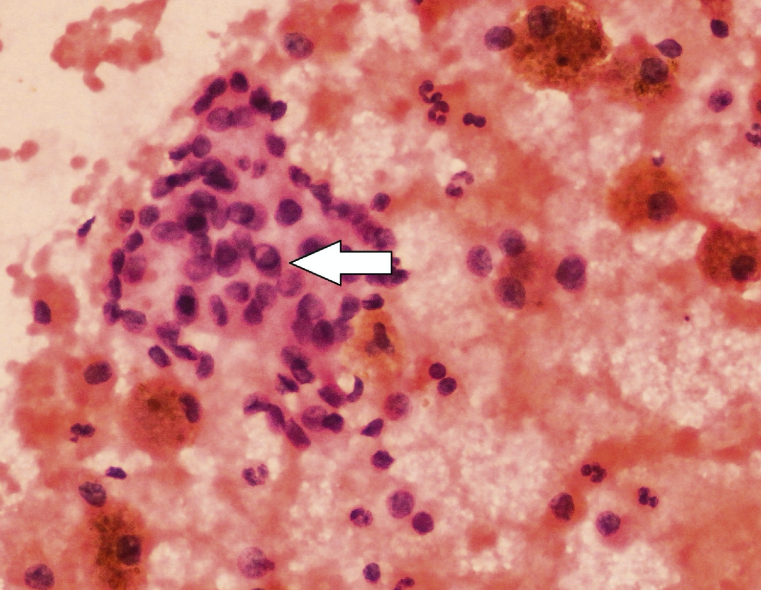 Citologia de PAAF de tireoide com pseudoinclusão intranuclear — carcinoma papilífero.