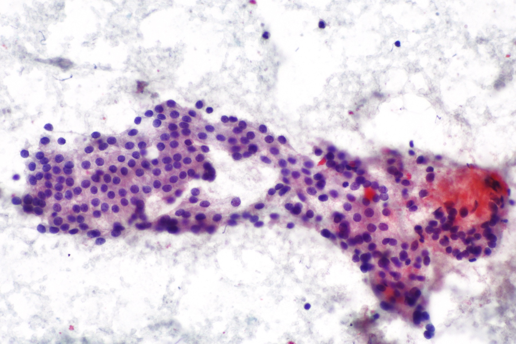 Citologia de tireoide com células de Hürthle, citoplasma oncocítico granular eosinofílico.