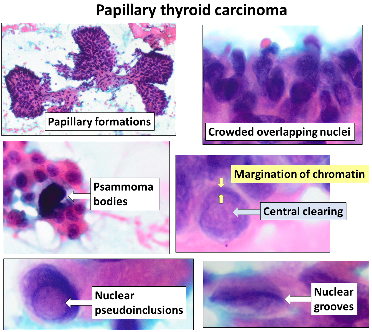 Citologia de PAAF de carcinoma papilífero com formações papilares e núcleos sobrepostos.