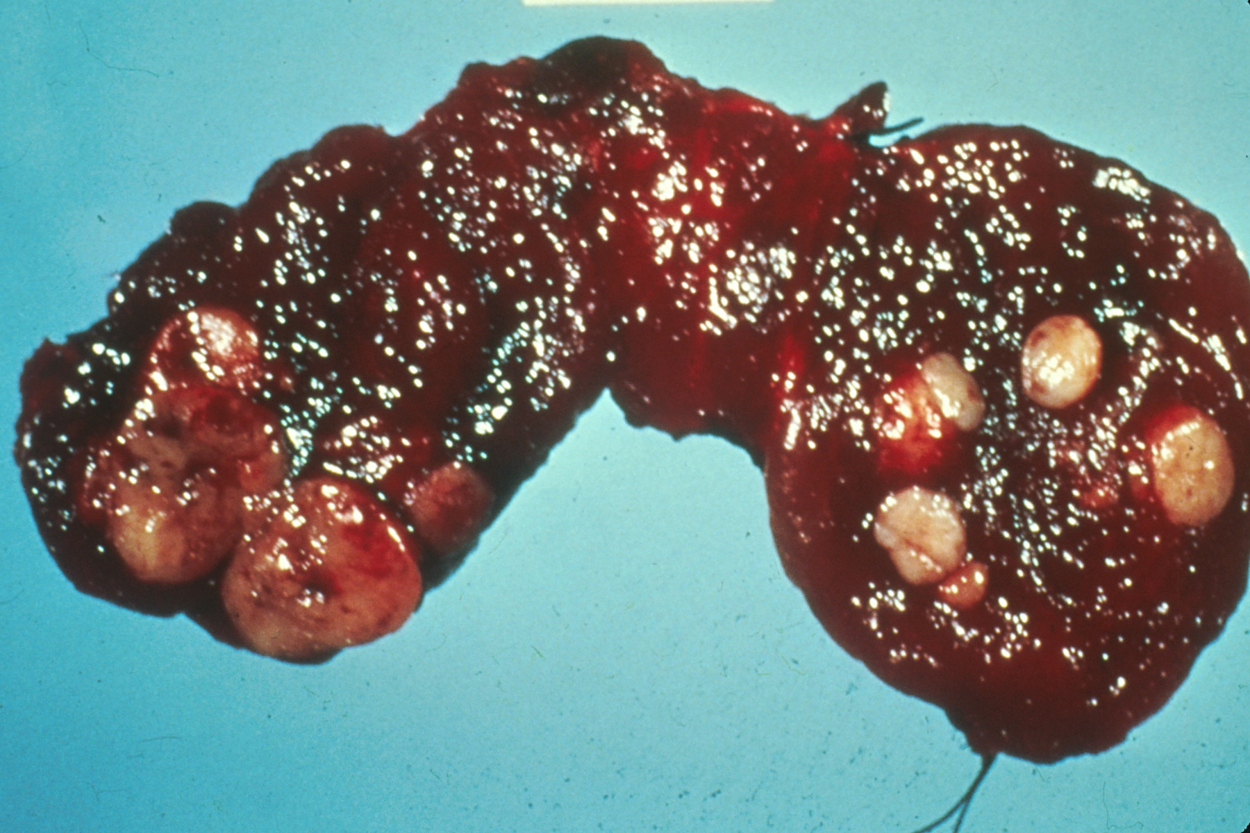 Peça macroscópica de tireoide humana com nódulos tumorais, mostrando a glândula seccionada e a relação dos nódulos com o parênquima.