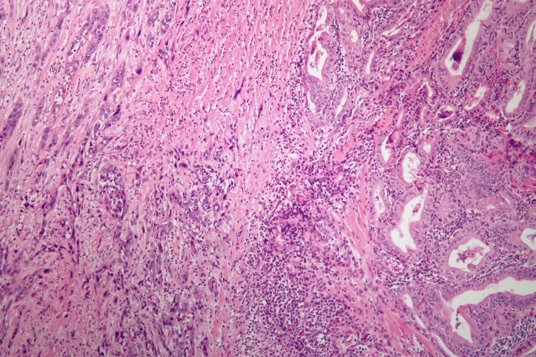 Histologia de carcinoma anaplásico de tireoide, células pleomórficas indiferenciadas.