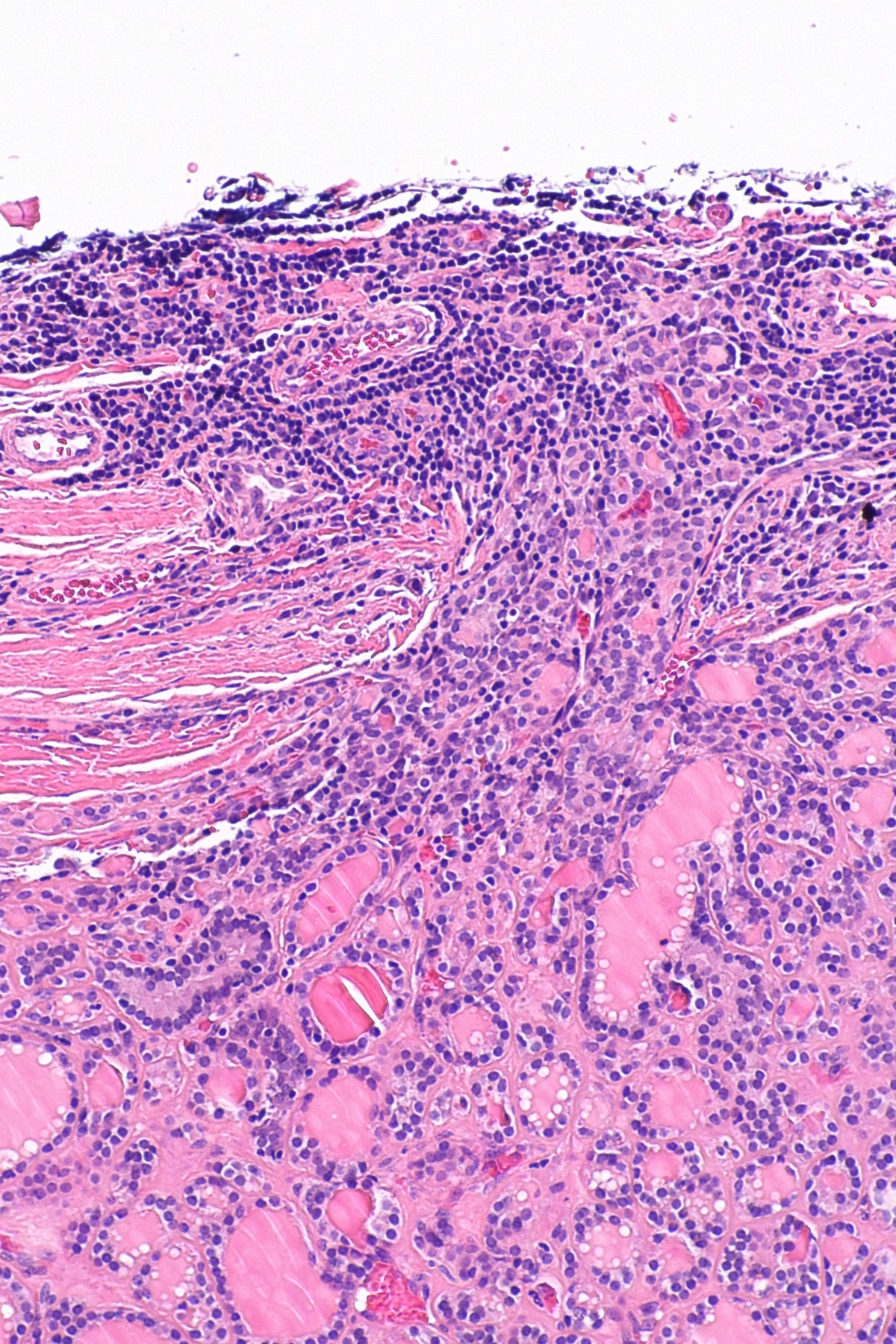 Histologia de carcinoma folicular da tireoide, padrão folicular.