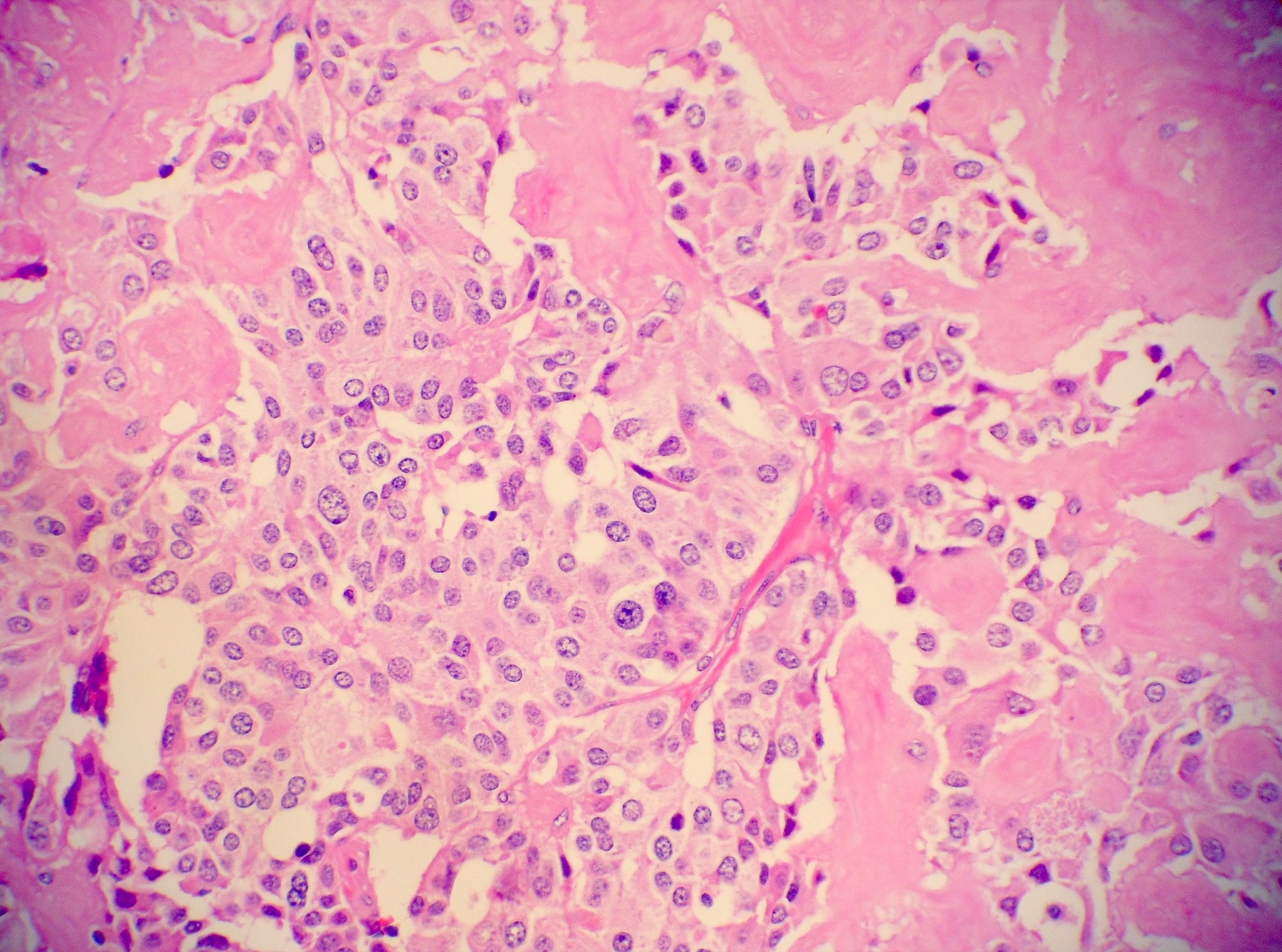 Histologia de carcinoma medular de tireoide com estroma amiloide.