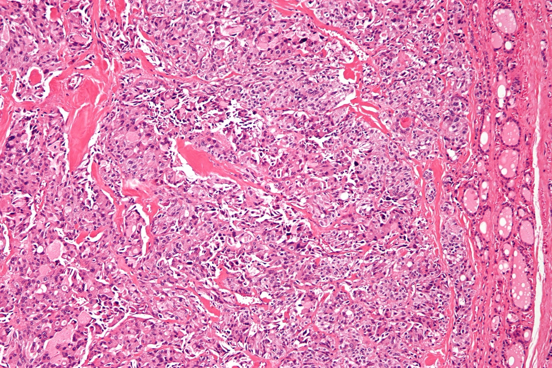 Histologia de carcinoma medular de tireoide, células neuroendócrinas dispostas em ninhos.