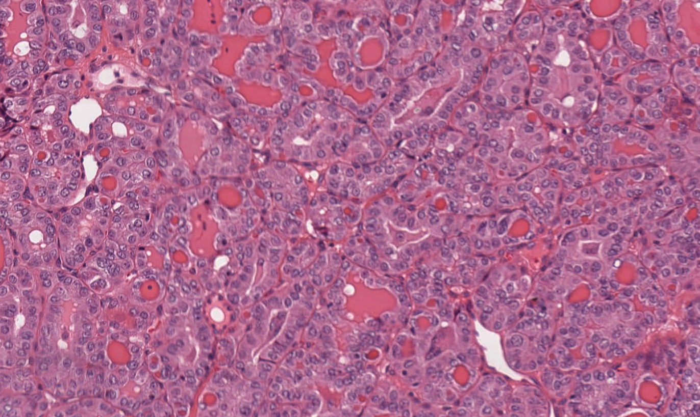 Histologia de carcinoma papilífero da tireoide: papilas verdadeiras revestidas por epitélio sobre eixos fibrovasculares.