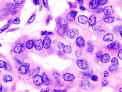 Histologia de carcinoma papilífero com arquitetura papilar e núcleos em vidro fosco, em peça de tireoidectomia total.
