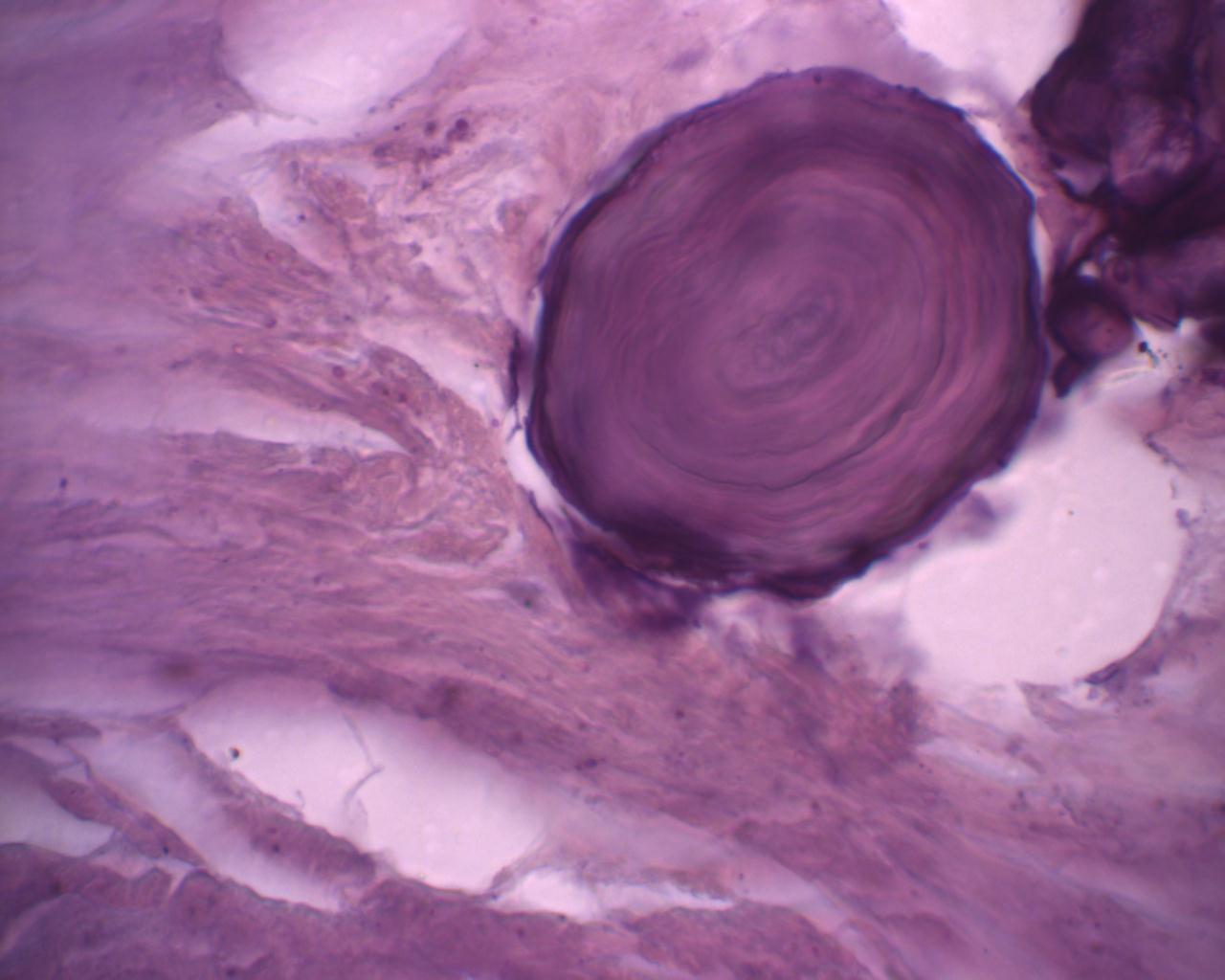 Histologia de carcinoma papilífero da tireoide com corpo psamomatoso (cálcio concêntrico).