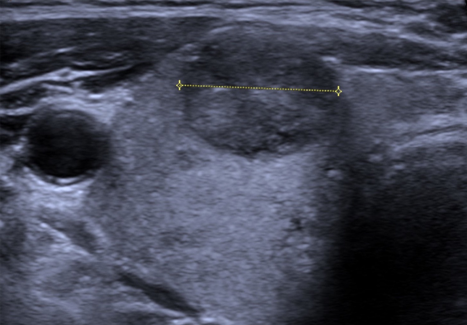 Ultrassonografia da tireoide em modo B mostrando nódulo hiperplásico moderadamente hipoecogênico, de contornos definidos, sem sinais de malignidade.