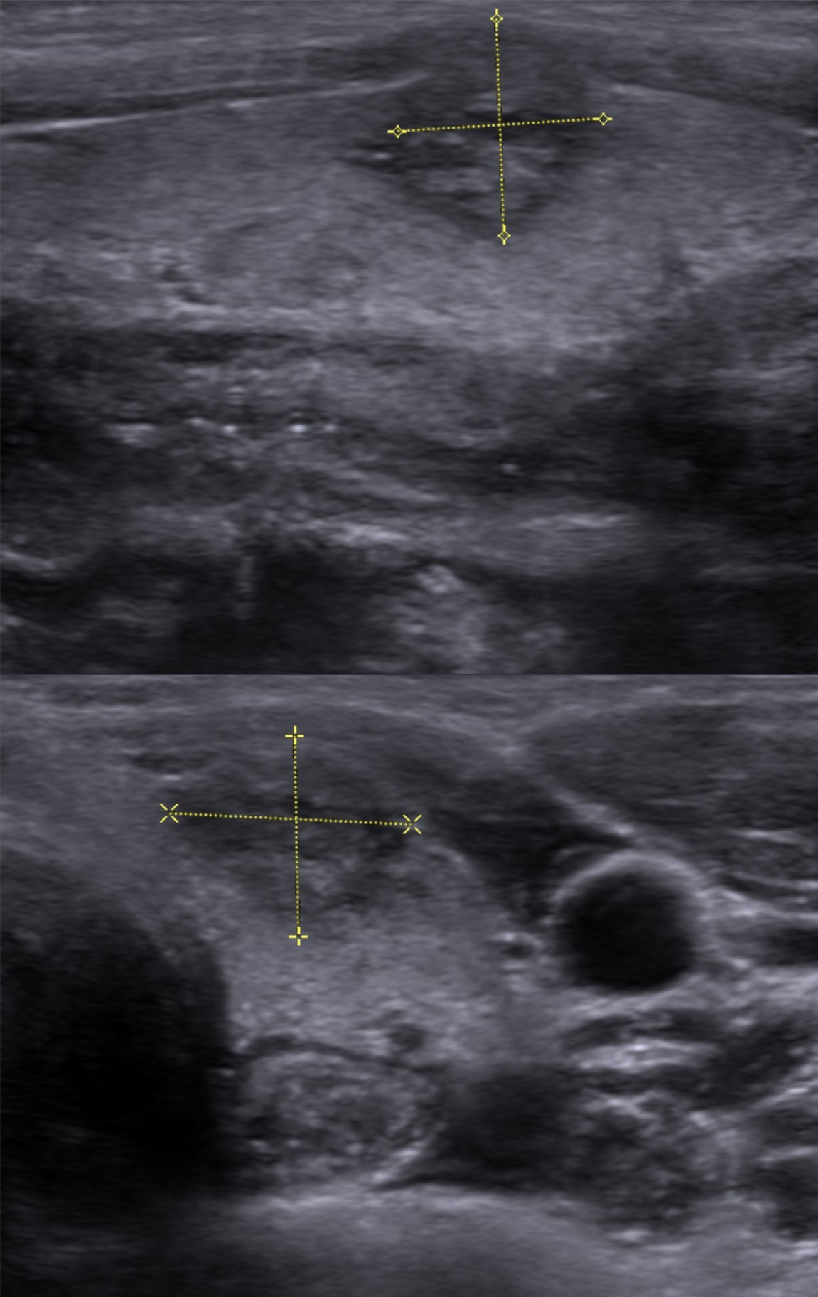 Ultrassom de carcinoma papilífero com extensão extratireoidiana: nódulo hipoecoico de margens infiltrativas invadindo o tecido adjacente — critério de TI-RADS 5. Cortes longitudinal (superior) e transversal (inferior).