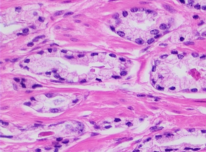 Micrografia (H&E) de adenocarcinoma de próstata, padrão acinar, com glândulas neoplásicas.