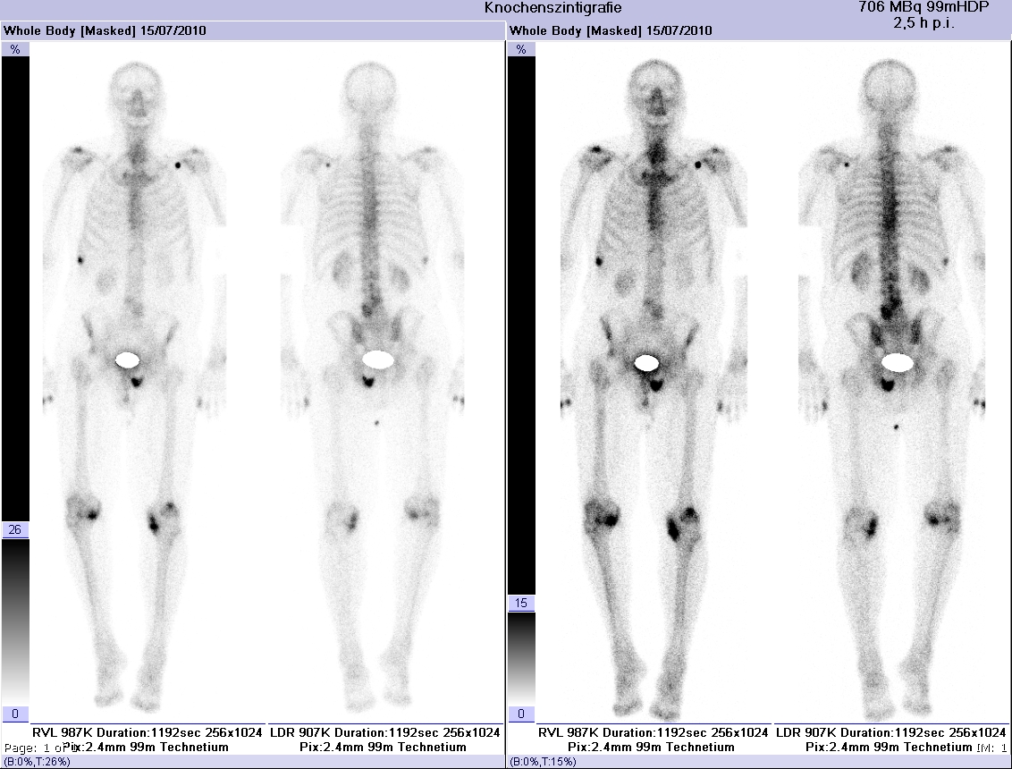 Cintilografia óssea com captação aumentada multifocal em coluna e pelve — metástases ósseas de câncer de próstata.