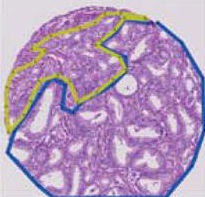Micrografia de adenocarcinoma de próstata com padrão de Gleason 7 (3+4), glândulas neoplásicas em diferentes graus de diferenciação.