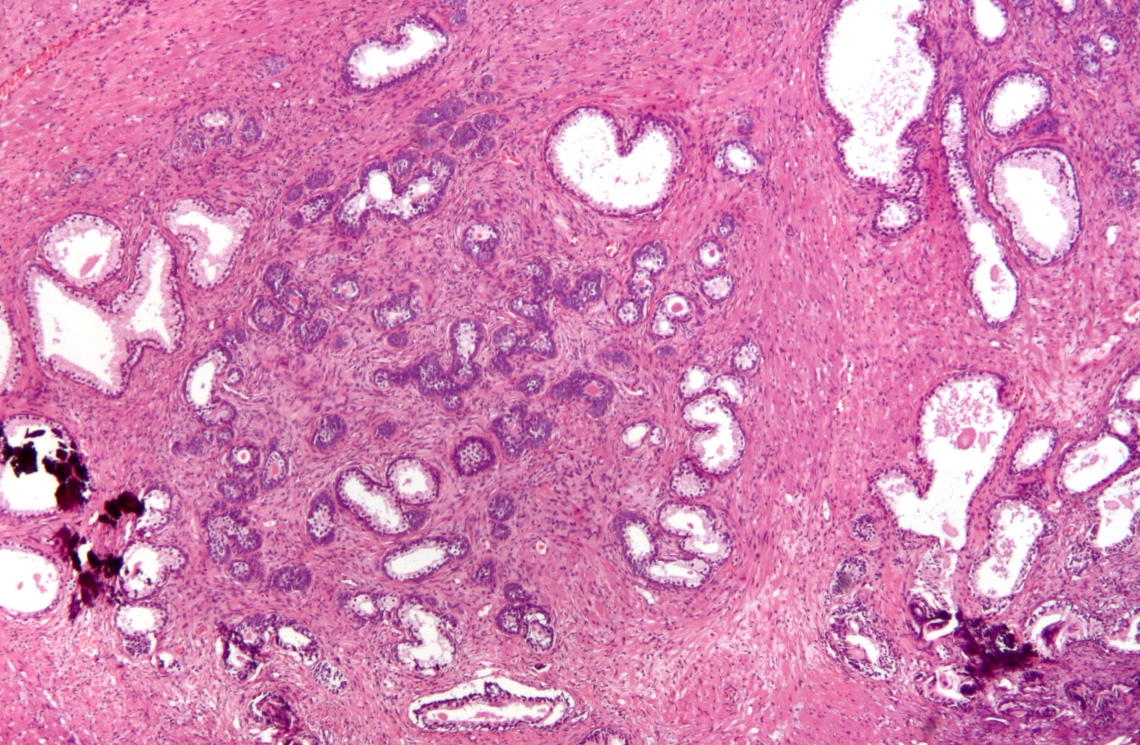 Micrografia de hiperplasia nodular benigna da próstata: nódulos de glândulas e estroma proliferados, sem atipia maligna.