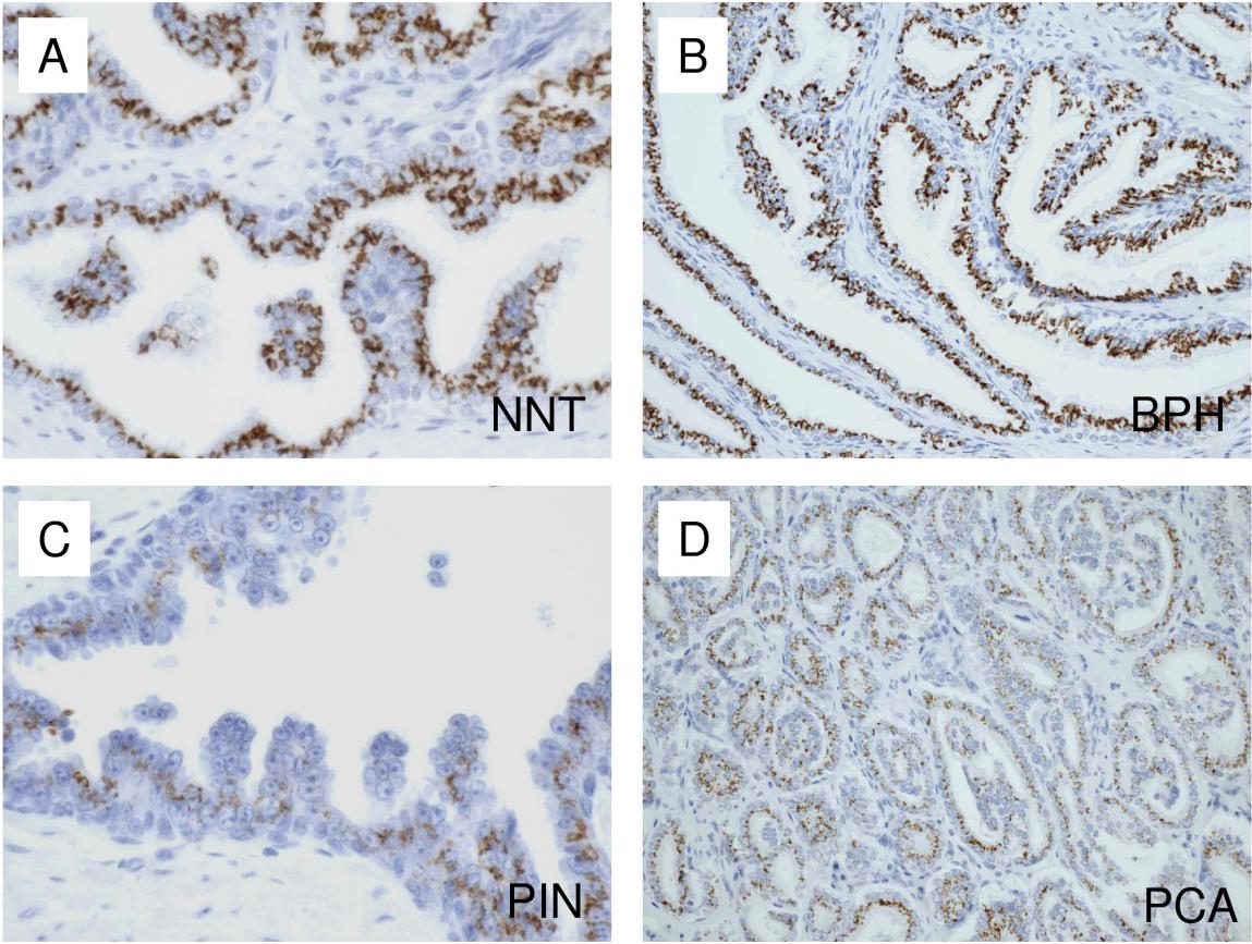 Painel de microscopia comparando epitélio prostático benigno e maligno por imuno-histoquímica.