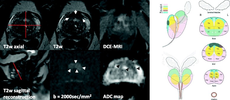 Ressonância multiparamétrica de próstata em painel: T2 axial e sagittal, DCE-MRI, difusão de alto valor b (b=2000) e mapa ADC, com setas sobre uma lesão focal de 20 mm na zona periférica — hipointensa em T2, hiperintensa na difusão e hipointensa no ADC. À direita, mapa setorial PI-RADS da próstata.
