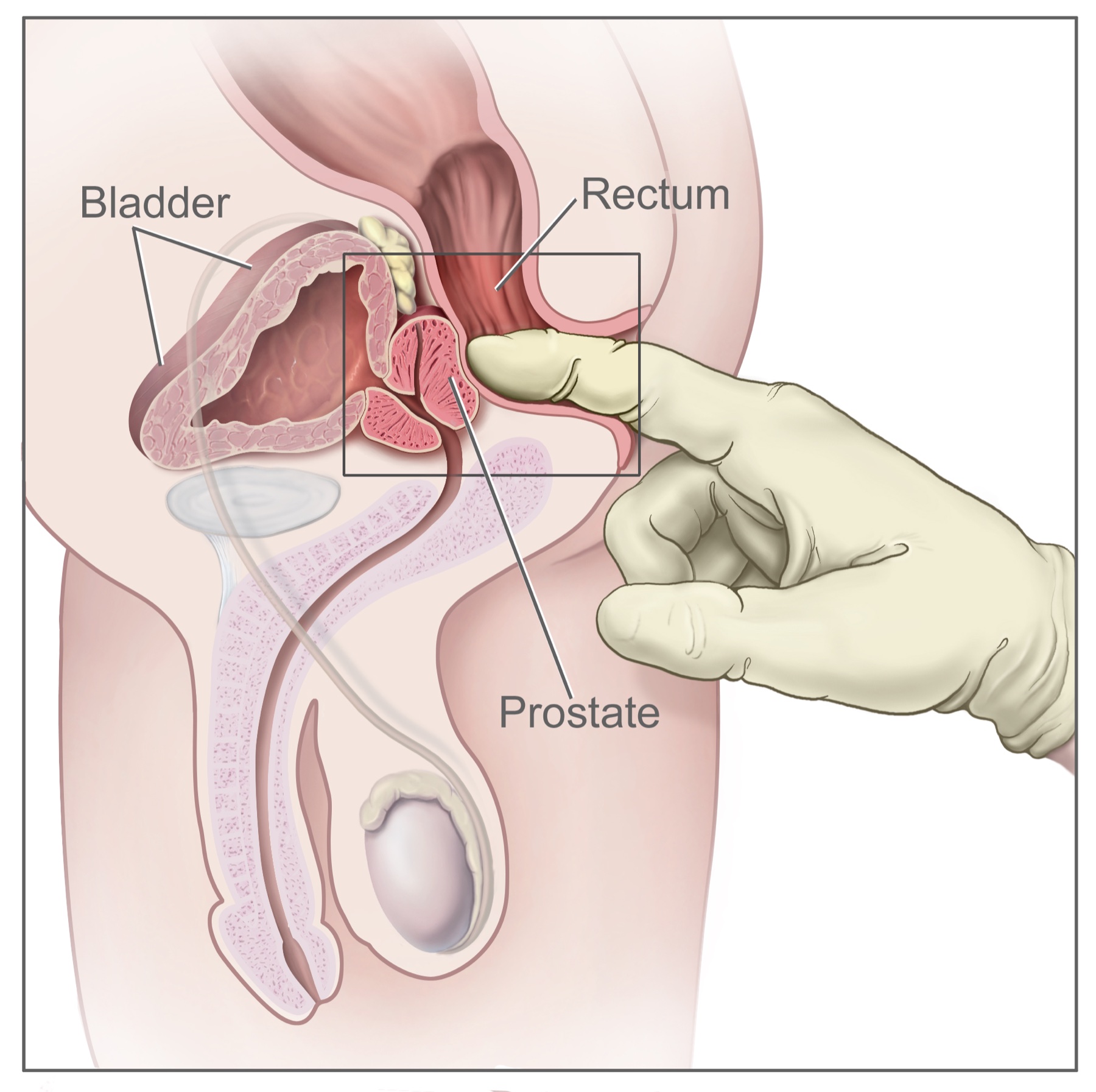 Toque retal: o dedo introduzido no reto alcança a face posterior da próstata, onde se palpa o nódulo endurecido de superfície irregular.