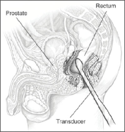 Ultrassonografia transretal da próstata em corte, modalidade usada para avaliar a glândula quando o rastreio (PSA + toque) levanta suspeita.
