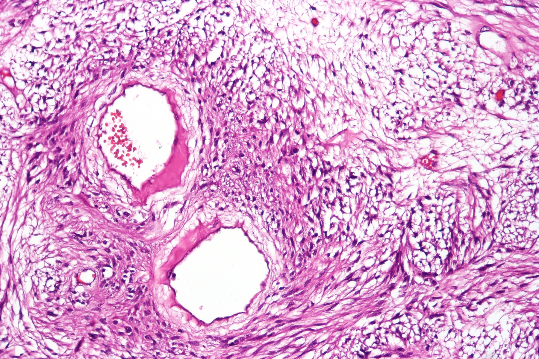Histologia H&E de GIST em grande aumento mostrando padrão fusocelular — feixes de células alongadas com estroma mixoide e vasos proeminentes.