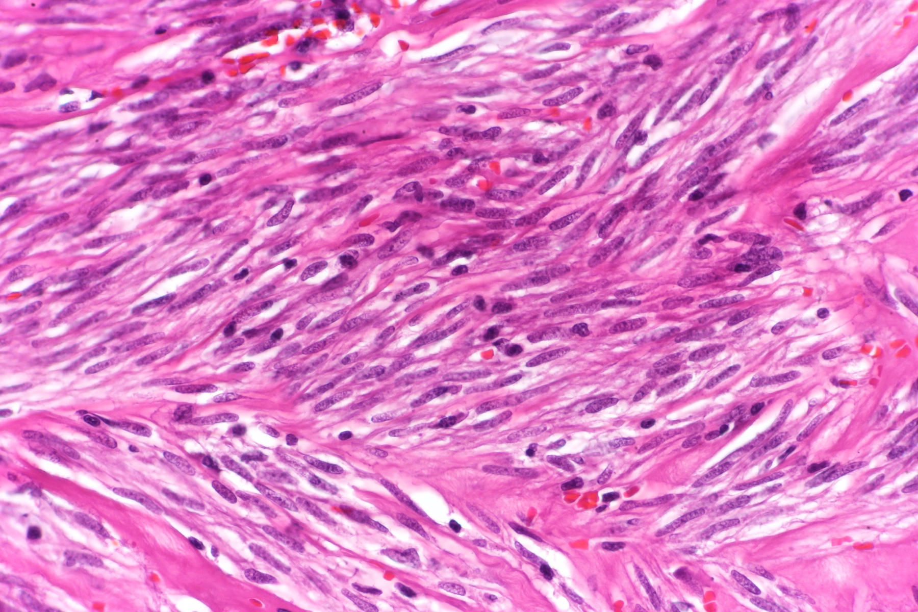 Histologia H&E de GIST gástrico em grande aumento mostrando padrão fusocelular — feixes de células alongadas com núcleos hipercromáticos.